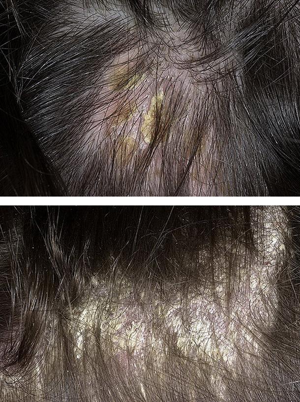 Жирная себорея волосистой части головы
