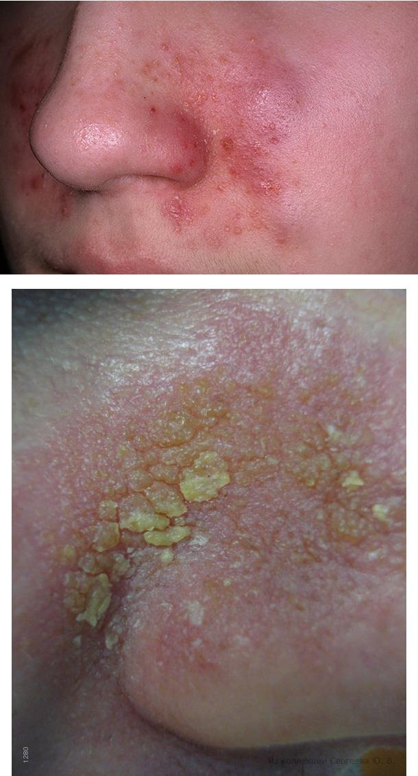 Жирная кожа с сухой себорейный дерматит