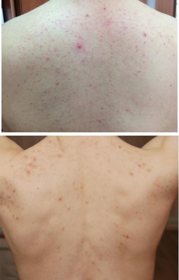 Аллергия после массажа подсолнечным маслом thumbnail