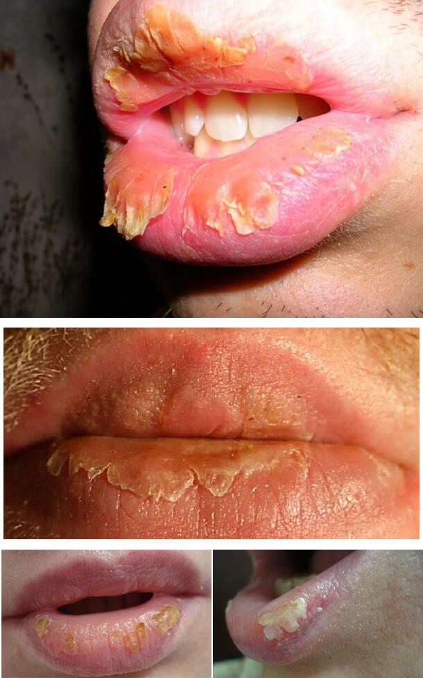 Эксфолиативное воспаление губ