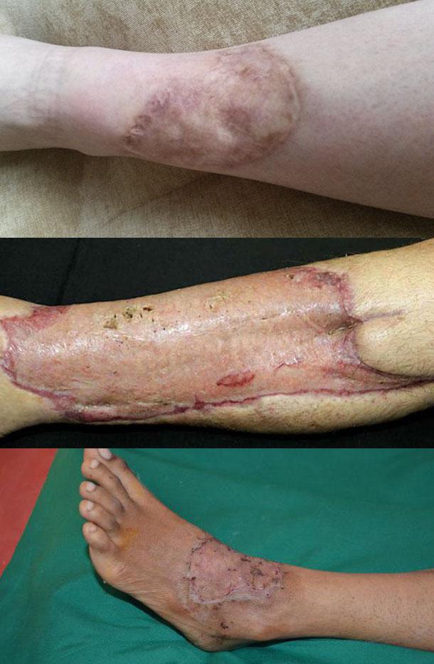 Осложнения после пересадки кожи на ноге