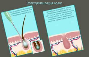 Электроэпиляция картинки для рекламы