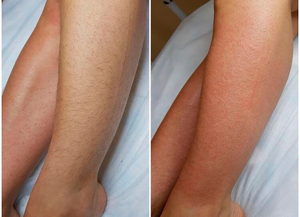 Ноги до и после лазерной эпиляции